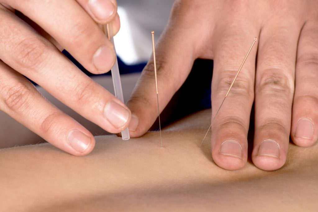 acupuncture needling